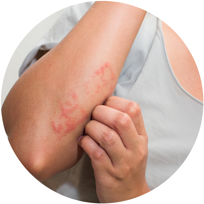 arquebusade skinproblem eczema2