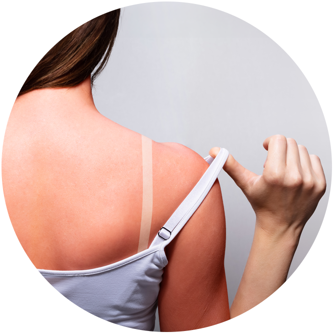 arquebusade skinproblem sunburn